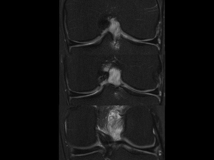 Figure 2 for case anterior cruciate ligament ( RID2781 )
